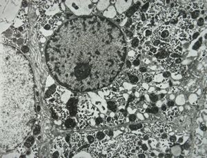 M,7y. | Wilson disease susp.